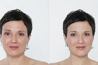 לפני ואחרי טיפול פילינג | צילום: Shutterstock