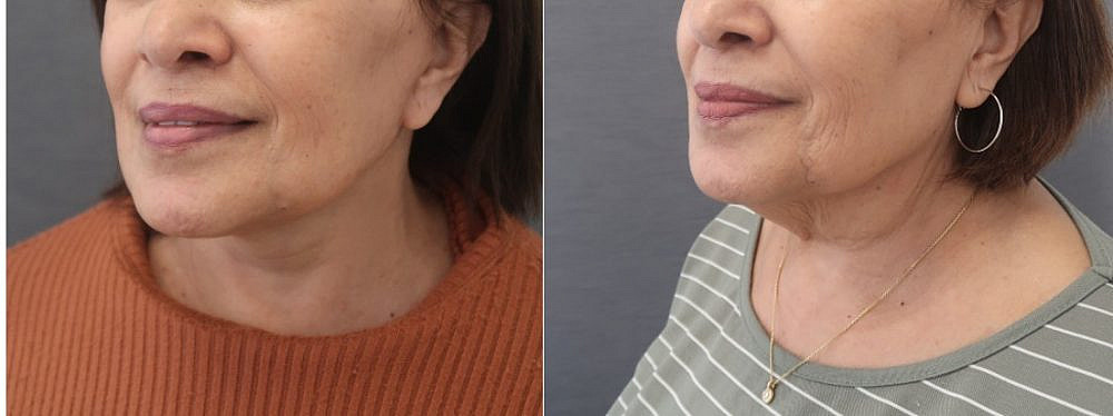 לפני ואחרי | צילום: יח"צ