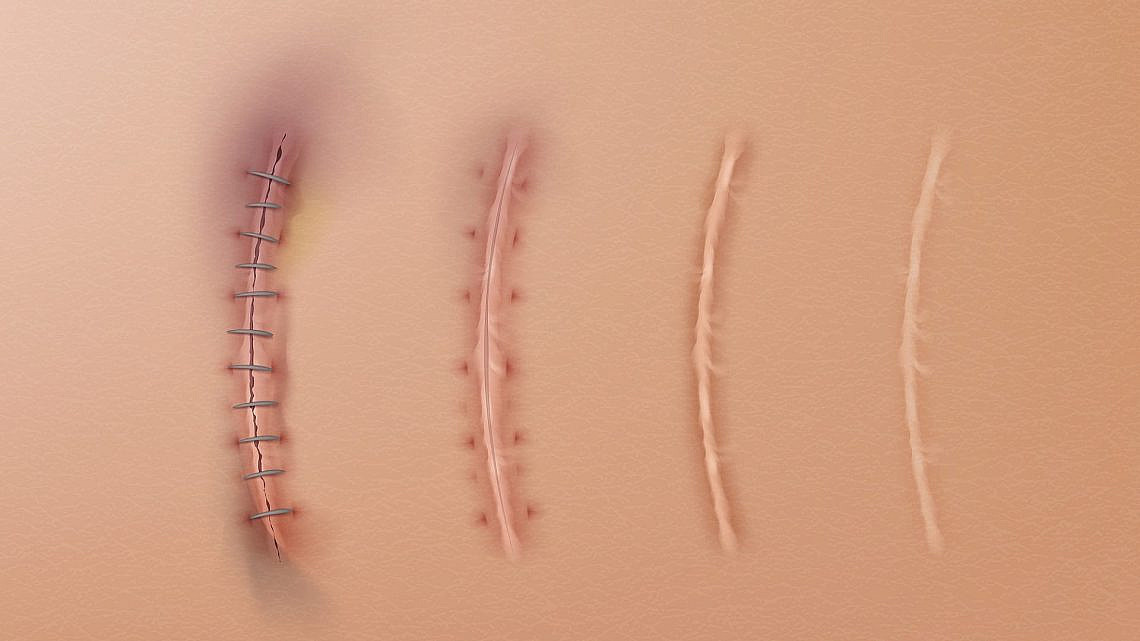 סוגי צלקות | צילום: יח"צ