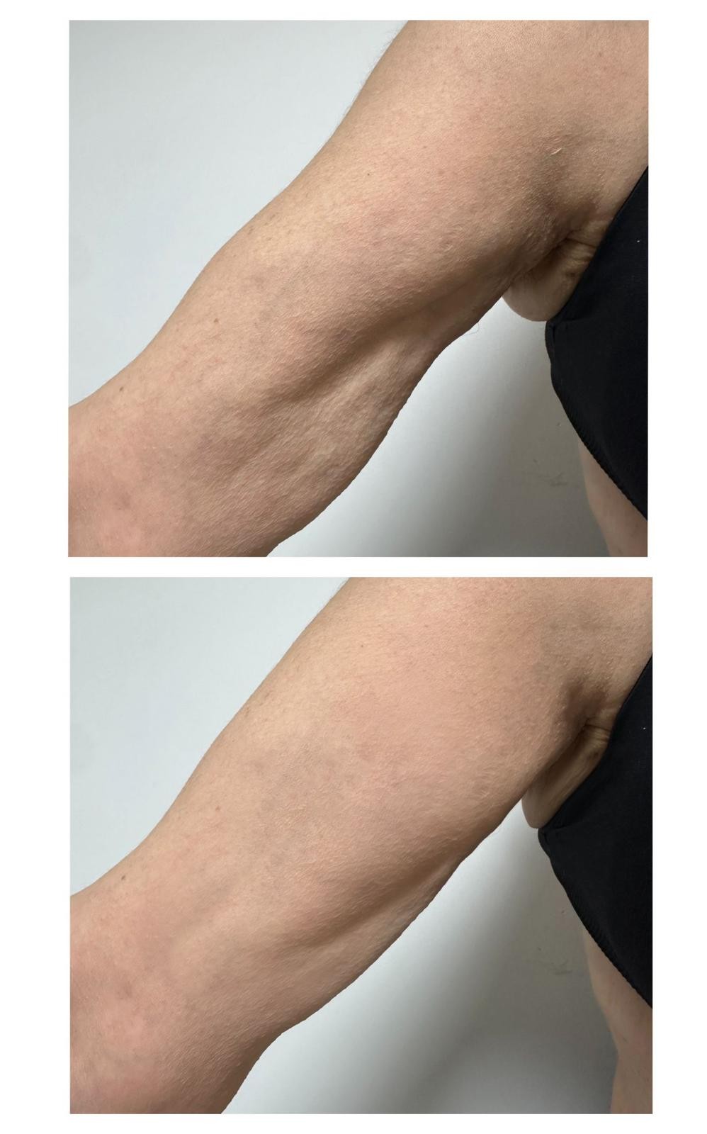 תמונת לפני אחרי של טיפול זרועות אצל ד"ר אירינה סנדלר. באדיבות המרפאה